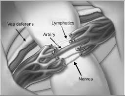 Микрохирургическая денервация семенного канатика